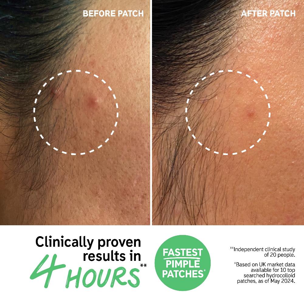 lookfantastic The INKEY List Hydrocolloid Unsichtbarer Pickel-Patches Bis zu 65% Rabatt